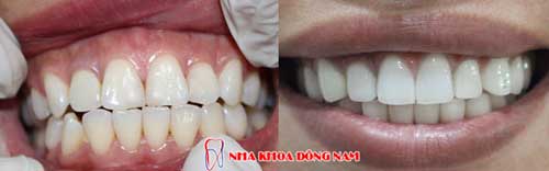 bọc răng sứ 4
