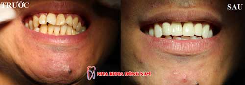 bọc răng sứ 5