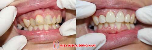 bọc răng sứ 7