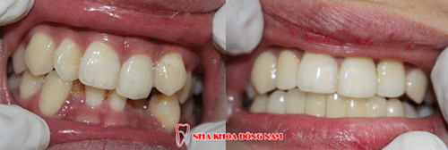 bọc răng sứ
