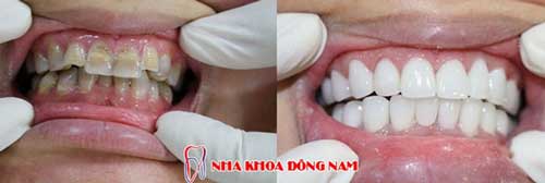 bọc răng sứ 9