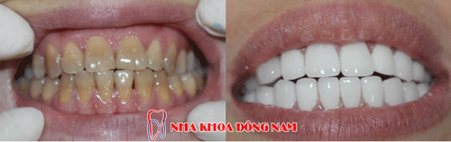 bọc răng sứ 2 hàm nhiễm kháng sinh ố vàng nặng