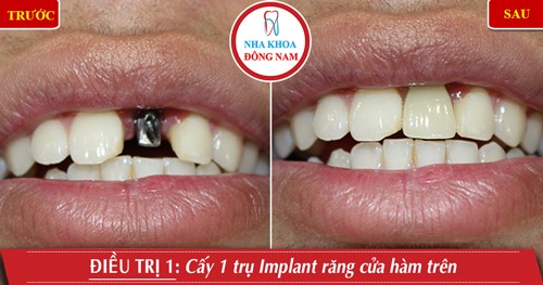 Cấy 1 trụ Implant răng cửa hàm trên