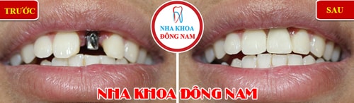 Trồng răng Implant cho trường hợp mất răng cửa