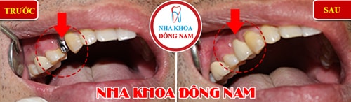 Cấy ghép Implant răng hàm