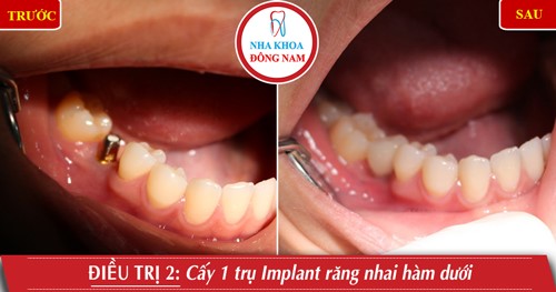 Cấy 1 trụ Implant răng hàm nhai hàm dưới