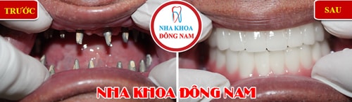 trồng răng implant 2 hàm cho trường hợp mất hết răng