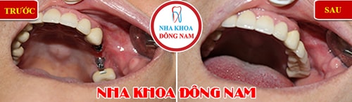 Cắm ghép Implant cho 2 răng hàm trên