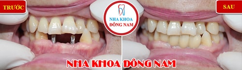 Cấy ghép Implant cho 2 răng cửa bị mất
