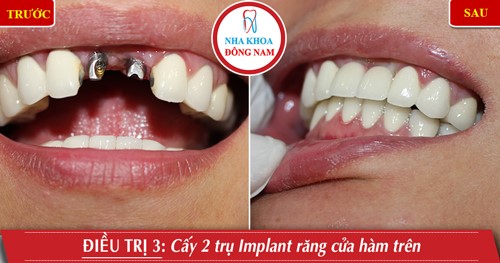 Cấy 2 răng implant răng cửa hàm trên