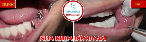 Cắm ghép implant và phục hình răng sứ cho trường hợp mất răng hàm nhai