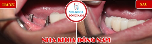 Cắm ghép implant và phục hình răng sứ cho trường hợp mất 3 răng hàm nhai