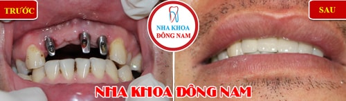 Cấy ghép implant 3 trụ gắn 4 răng cửa hàm trên