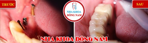 cấy ghép răng implant 3 trụ hàm nhai và phục hình 4 răng sứ