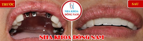 trồng răng Implant 3 trụ gắn 4 răng cửa