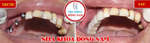 Cắm ghép implant răng hàm trên cho trường hợp mất 3 răng