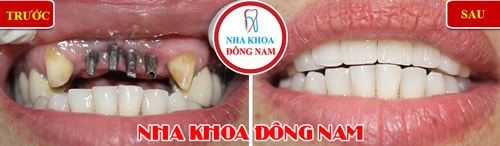 trồng răng implant cho trường hợp mất 4 răng cửa hàm trên