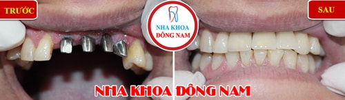 Cắm ghép Implant - Cấy 4 trụ Implant răng cửa
