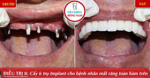 Cấy 5 trụ implant cho bệnh nhân mất răng toàn hàm trên