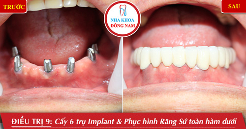 Cấy 5 trụ implant phục hình răng sứ toàn hàm dưới