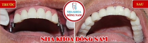 Cắm ghép implant răng hàm nhai