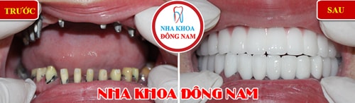 trồng răng Implant toàn hàm trên phục hình 2 hàm răng sứ