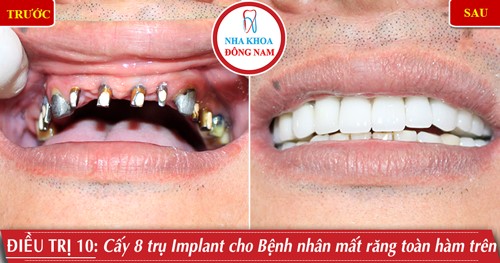 Cấy 8 trụ Implant phục hình răng sứ toàn hàm trên