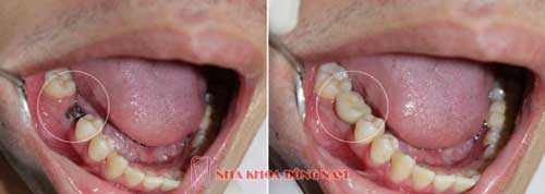 cấy ghép 1 trụ implant cho răng nhai số 6