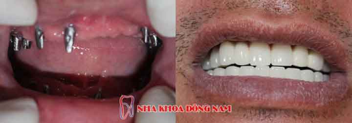cấy ghép 14 trụ implant cho 2 hàm răng mất