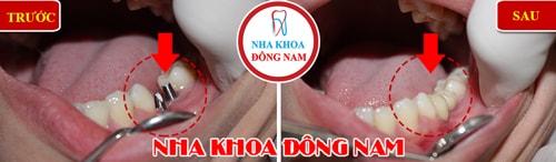 Cấy ghép implant cho trường hợp mất 2 răng hàm dưới