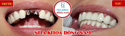 trồng răng Implant và phục hình răng sứ cho 2 răng cửa bị mất