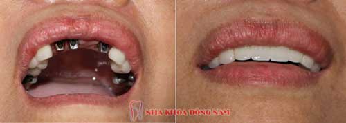 cấy ghéo 3 trụ implant răng cưa hàm trên