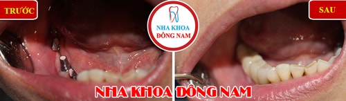 Cắm ghép implant răng hàm nhai cho trường hợp mất 3 răng