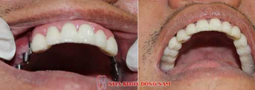 cấy ghép 6 trụ implant cho 2 hàm răng nhai bị mất