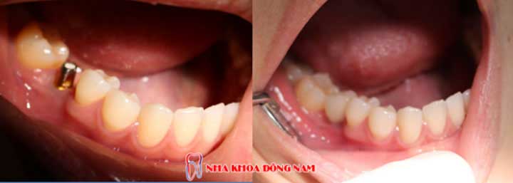 cấy ghép implant 1 răng nhai bị mất