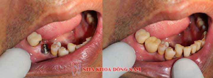 (*Lưu ý: Tùy từng tình trạng bệnh nhân khác nhau sẽ có kết quả bọc răng sứ khác nhau)
