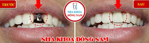 Cấy ghép implant 1 trụ răng cửa