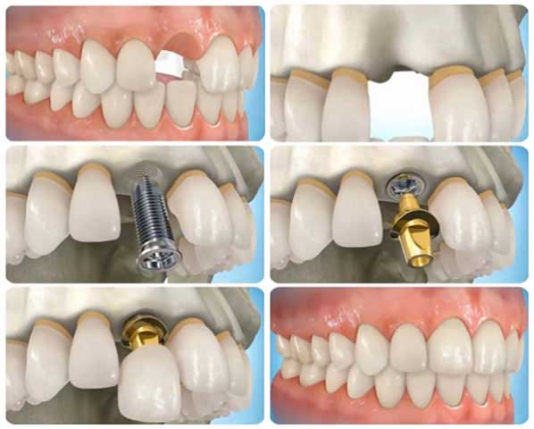 cấy ghép implant