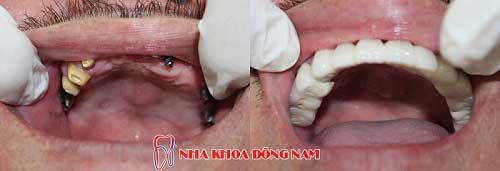 cấy ghép implant 2 hàm