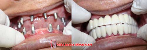 (*Lưu ý: Tùy từng tình trạng bệnh nhân khác nhau sẽ có kết quả bọc răng sứ khác nhau)