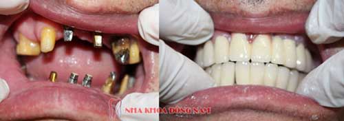 cấy ghép implant 2 hàm răng mất 2
