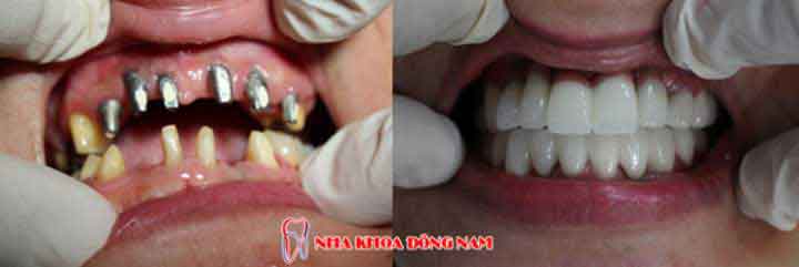 cấy ghép implant 2 hàm răng mất 3