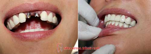 cấy ghép răng implant 2 răng cửa bị mất 1
