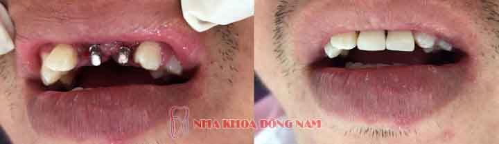 cấy ghép răng implant 2 răng cửa bị mất 2