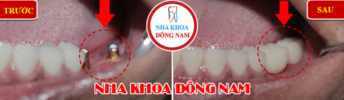 Cấy ghép implant 2 trụ răng hàm dưới
