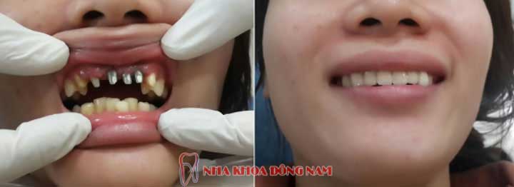 cấy ghép răng implant 3 răng cửa bị mất