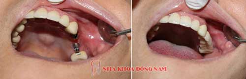 cấy ghép implant 3 răng nhai hàm trên