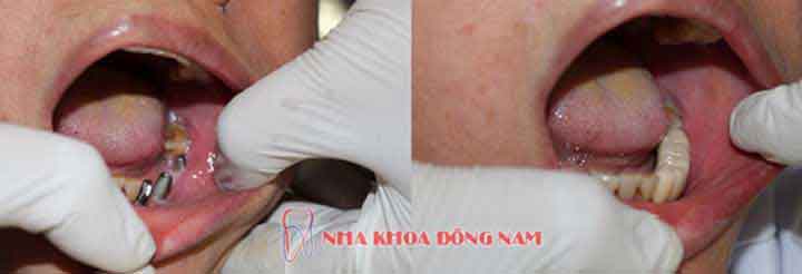 cấy ghép implant 4 răng nhai hàm dưới