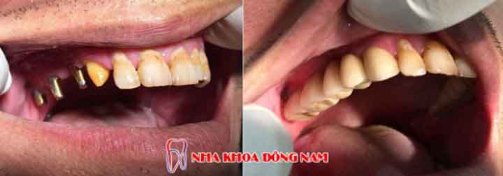 cấy ghép implant 4 răng nhai hàm trên