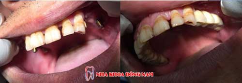 cấy ghép implant 4 răng nhai hàm trên 2